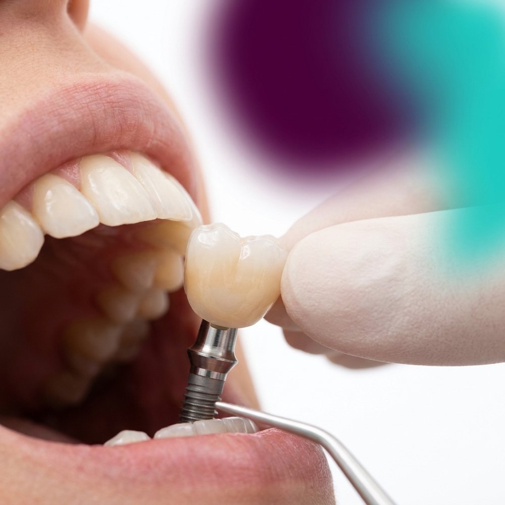 Coroa de cerâmica sendo posicionada sobre implante dentário